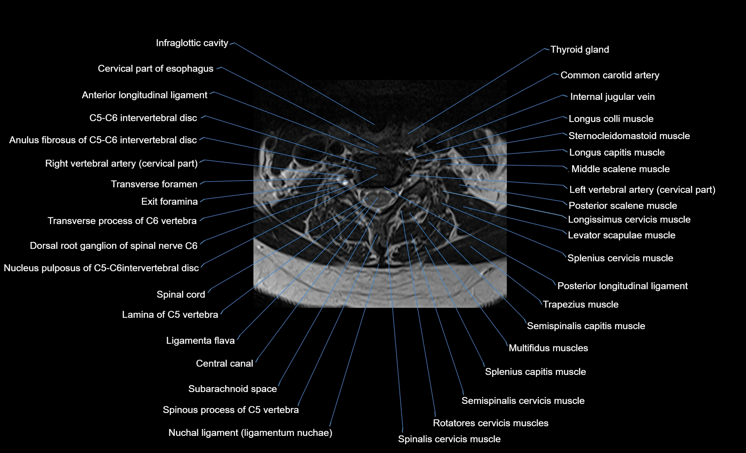 cervical spine cross sectional MRI anatomy  3T MRI axial  image-img-00001-00029.webp
